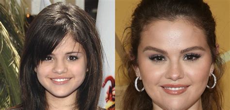 what surgery did selena gomez have